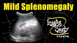 Mild Splenomegaly  Ultrasound  Case 150 [upl. by Latsyrhc249]