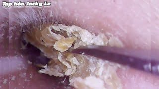 Ear Wax Removal 170 He was tormented by itchy ears every night  Ear Cleaning ASMR [upl. by Hale11]