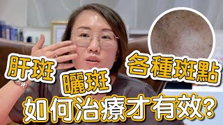 肝斑、色素不均是如何造成？來看看莊盈彥醫師治療肝斑的方式有哪些！ [upl. by Merow]