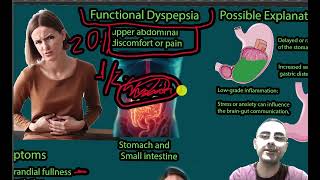 Functional Dyspepsia Upper Abdominal pain Epigastric pain Symptoms causes and treatment [upl. by Dragone]