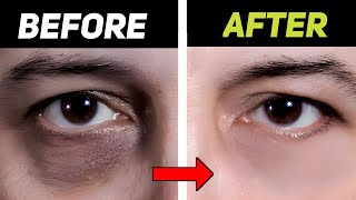 Remove Dark Circles In Just 2 Days [upl. by Aida]