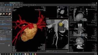 Vitrea Demonstrations  EP Planning [upl. by Noryk609]