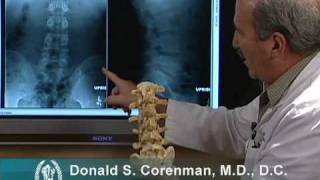 How to Read Xrays of the Lumbar Spine Lower Back  Spine Surgeon Colorado [upl. by Nysila]