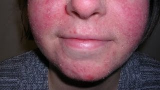 How to Treat Facial Eczema DermTVcom Epi 479 [upl. by Leelahk]