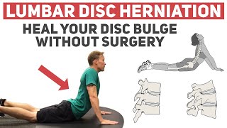 How to Heal Your Disc Herniation Without Surgery [upl. by Dyna849]