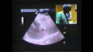 IR Liver Cancer Live Microwave Ablation Treatment without Surgery  Dr Samir Abdelghaffar [upl. by Telimay]