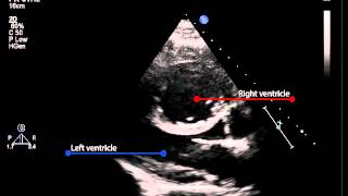 3B Parasternal long axis view of the left ventricle pulmonary hypertension [upl. by Nlyak]