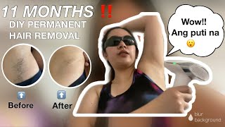 11 Months using LESCOLTON IPL in my UNDERARM DIY PERMANENT HAIR REMOVAL Ricalyn D [upl. by Oderf211]