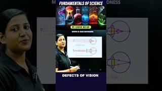 Defects of Vision and their Correction  Science By Sakshi Maam ssc ssccgl chsl radiangurukul [upl. by Wemolohtrab]