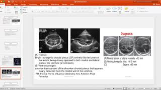 hydrocephalusventriculomegaly [upl. by Alil]