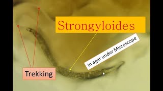 Strongyloidiasis cause and its pathogenesis Strongyloides under microscope [upl. by Chesna]