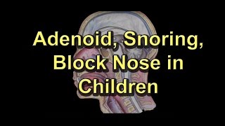 Adenoiditis Adenoid Surgery Snoring Block noseRunny nose in children [upl. by Geminius]