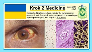 Krok 2 Medicine  Year 2019  045 Ministry of Public Health of Ukraine [upl. by Lertnahs]