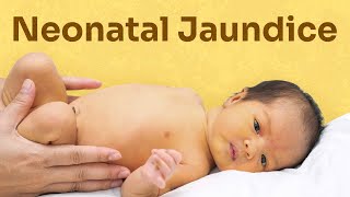 ABO incompatibility leading to neonatal jaundice neonataljaundice ABOincompatibility paediatrics [upl. by Darken]