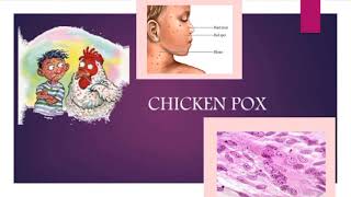 CHICKENPOX  Definition of chickenpox  Symptoms of chickenpox💯 [upl. by Gwenni]