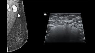 Impregnação de linfonodos axilares por silicone Achados da mamografia e da ultrassonografia [upl. by Aura]