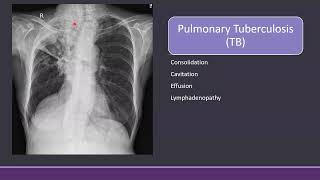 Chest Xray in Tuberculosis cxr TB radiology [upl. by Fran121]