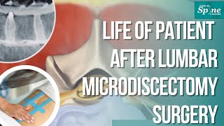 Life of Patient after Lumbar Microdiscectomy Surgery  Recovery Post OP Complete Info in English [upl. by Onitsuaf543]