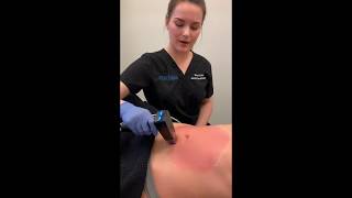 Morpheus8 Treatment to Abdomen  Dr David P Rapaport NYC [upl. by Jard]