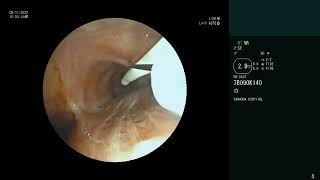 Endobronchial Lipoma  Bronchoscopic removal  Rigid Bronchoscopy  Snaring  Cryoextraction [upl. by Ailhat]