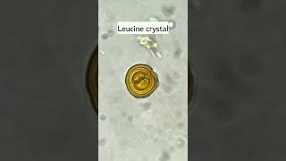 Leucine crystals in urine under microscopeurinalysismicroscopyurology [upl. by Hiltan]