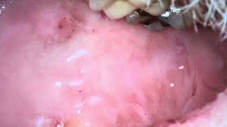 Leukoplakia oral sores part 111 [upl. by Selie741]