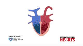 Ventricular Septal Defect [upl. by Neleag]