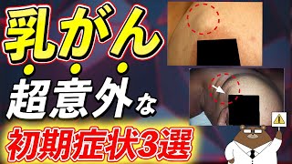 放置厳禁！絶対に見逃さないで！知らないと後悔する乳がんの危険サインとは？予防法は存在するの？ [upl. by Kissiah]