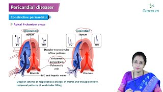 Pericardial Disease Hindi  Etiology Clinical Features Diagnosis Treatment and Complications [upl. by Hubing221]