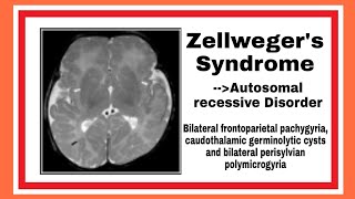 Zellwegers Syndrome [upl. by Eiser277]