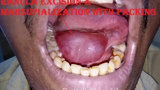 Ranula Excision amp Marsupialization with Packing [upl. by Thurlough36]