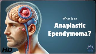 Anaplastic Ependymoma Explained Symptoms Treatment and Hope [upl. by Oirelav]