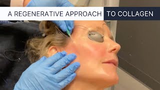 PDO Thread Lift the Ultimate NonSurgical Facelift [upl. by Dosia]