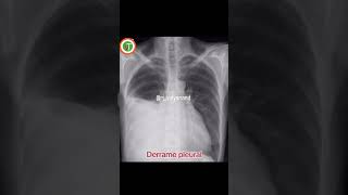 trending Chest xray Normal neumoniacardiomegaglia metastasispulmonarcovid19 mbbs college [upl. by Aicital]