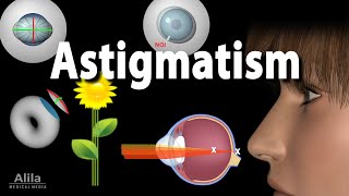 Astigmatism Types Causes Symptoms and Treatment Options Animation [upl. by Brandice]