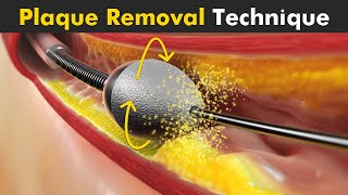 How Atherectomy is Performed  Removal Of Plaque From Arteries [upl. by Yssirhc]