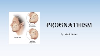 Pathophysiology of prognathism in acromegaly [upl. by Elamef69]