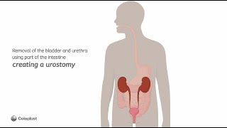 Creation of urostomy by removing bladder urethra  Ostomy surgery  Coloplast India [upl. by Anialem]