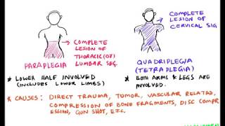 spinal cord injury part1 classification paraplegia quadriplegia [upl. by Jordan348]