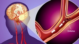 Stroke Prevention amp Transient Ischemic Attack TIA [upl. by Sorkin]