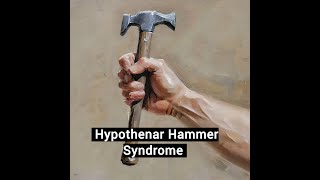 Hypothenar Hammer Syndrome [upl. by Shaffert649]