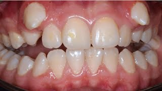 Orthodontic Treatment of Ectopic Canines Smile Transformation with Braces [upl. by Nibas]