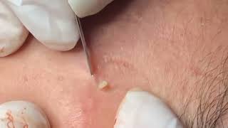 how to remove blackheads from nose with tool removeblackhead [upl. by Drarehs986]