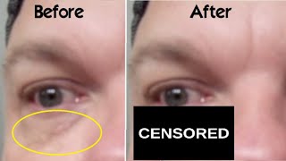 How Use Trichloroacetic Acid on Xanthelasma Spots Around Eyes at Home WARNING My BAD Experience TCA [upl. by Aicilegna]