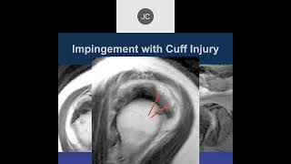 MR of Shoulder Impingement 2023 [upl. by Ahseihs132]