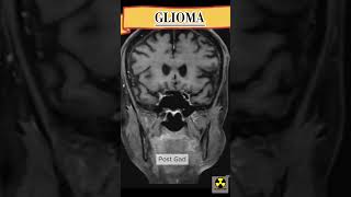 MRI Brain  GLIOMA mriscan medicalimaging See description [upl. by Martainn]