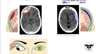 Hemorrhagic stroke epidural amp subdural hematoma  USMLE Step 1 [upl. by Sirapal305]