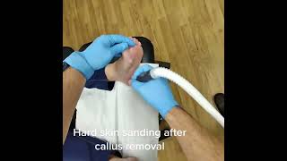 Unveiling smooth feet postscalpel Podiatrist magic – Hard skin sanding PodiatryWin FootCare [upl. by Aven]