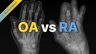 Osteoarthritis OA vs Rheumatoid Arthritis RA Explained  XRay Examples [upl. by Alacim]