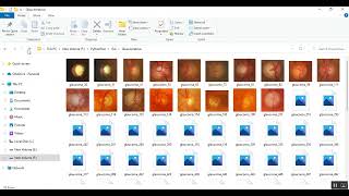 Glaucoma detection in fundus image using CNN [upl. by Aerdnuahs221]